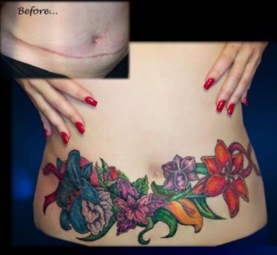 tatouage cicatrice ventre