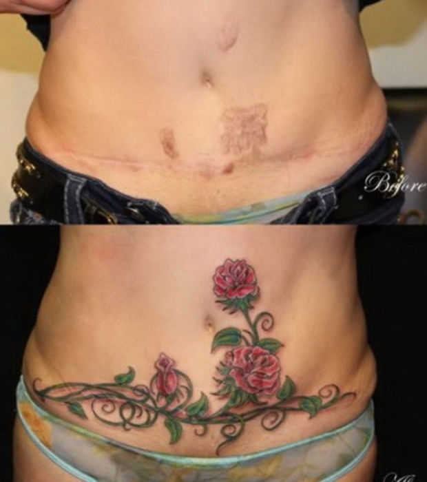 tatouage cicatrice ventre