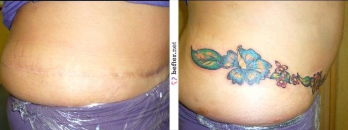 tatouage ventre cesarienne